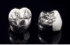 二本の銀歯の画像